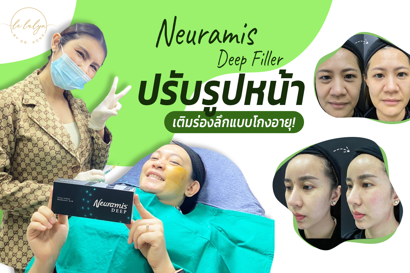 Neuramis Deep Filler ปรับรูปหน้า อัพหน้าเด็ก เติมร่องลึกแบบโกงอายุ!